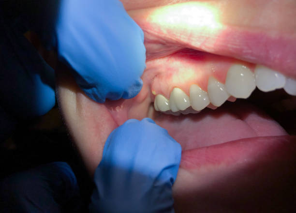 Best Emergency Root Canal Therapy in Shenandoah Farms, VA